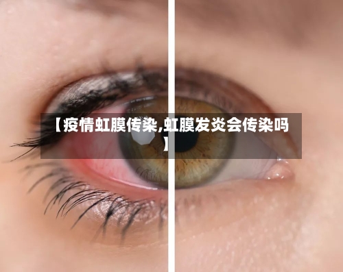 【疫情虹膜传染,虹膜发炎会传染吗】-第2张图片